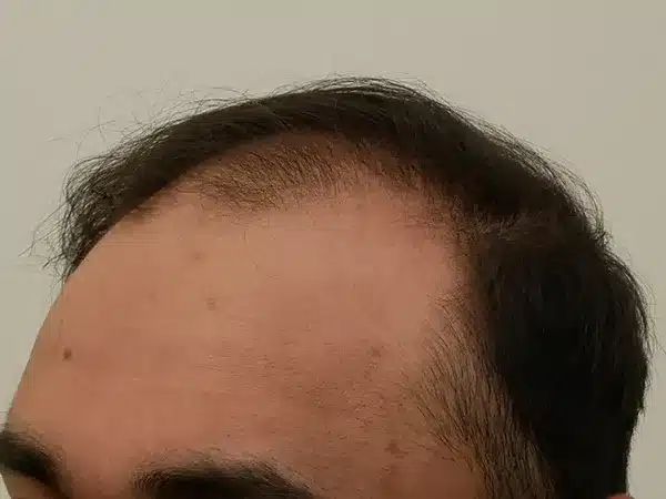 Hair Restoration