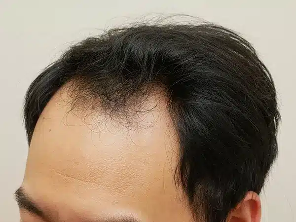 Hair Restoration