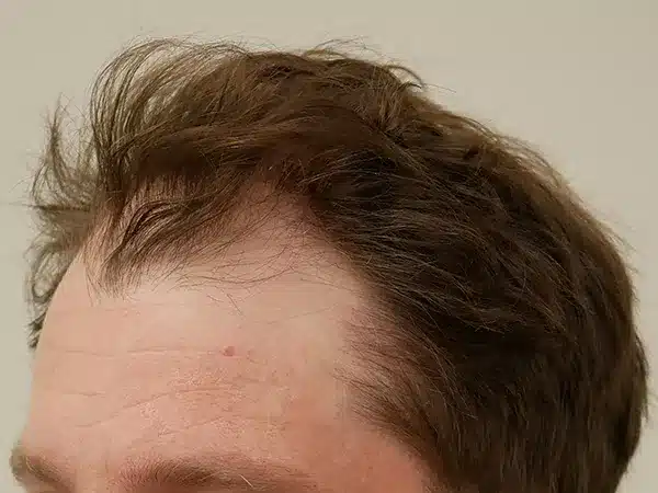 Hair Restoration