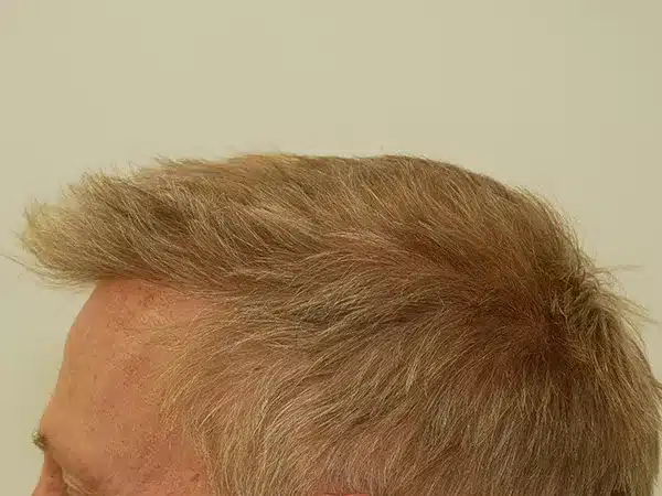 Hair Restoration