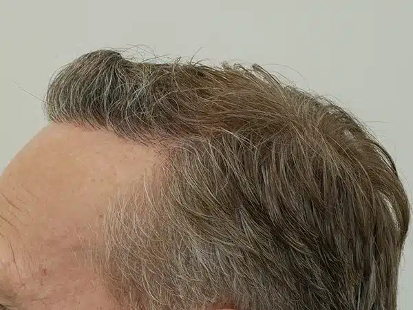 Hair Restoration