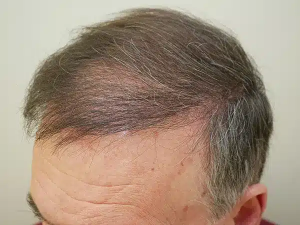 Hair Restoration
