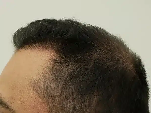 Hair Restoration