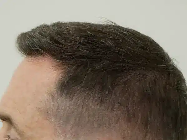 Hair Restoration