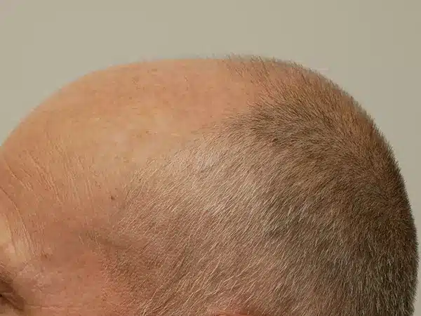 Hair Restoration