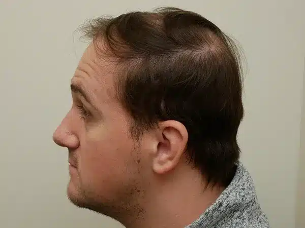 Hair Restoration