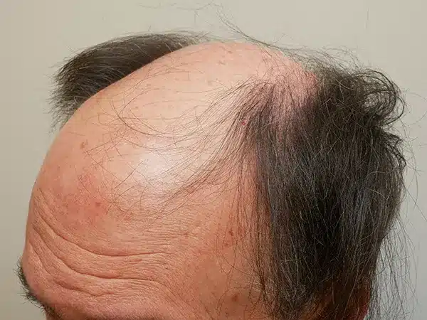 Hair Restoration