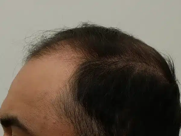 Hair Restoration
