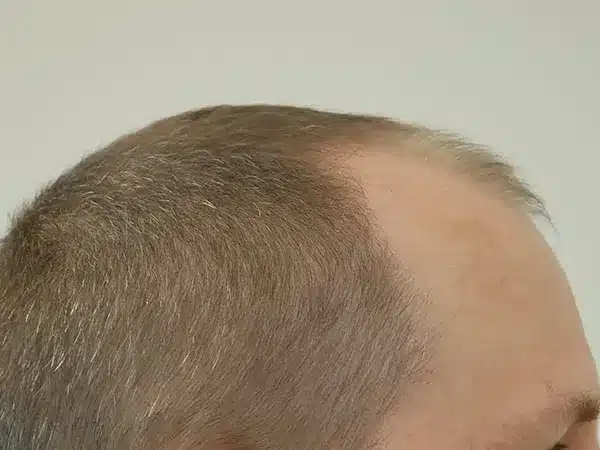 Hair Restoration