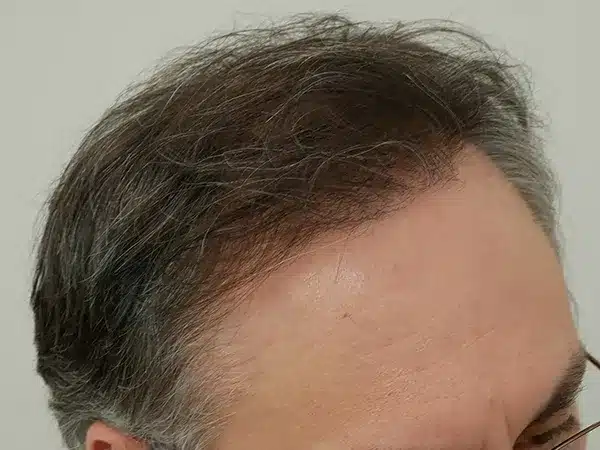 Hair Restoration