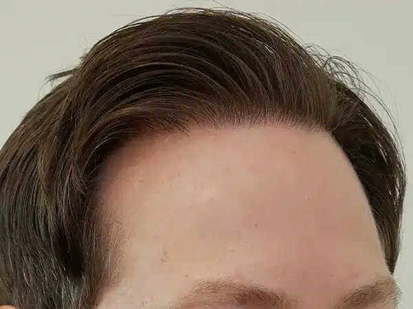 Hair Restoration