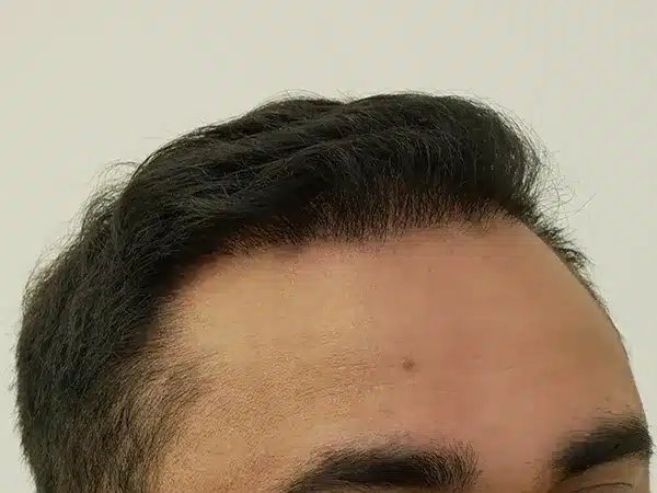Hair Restoration