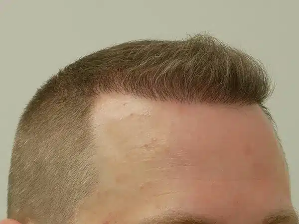 Hair Restoration