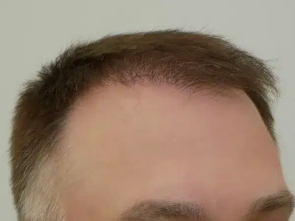 Hair Restoration