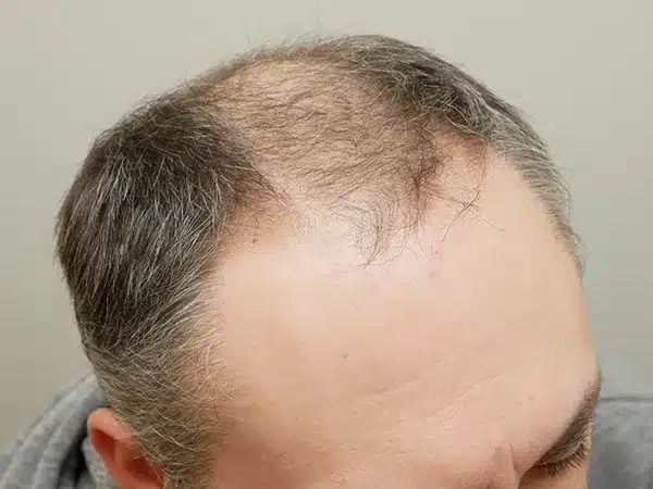 Hair Restoration