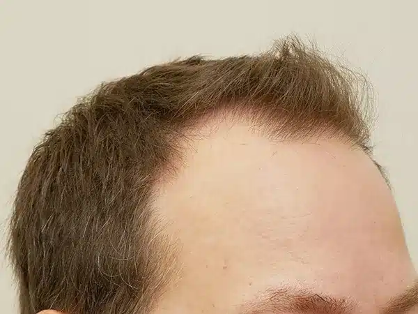 Hair Restoration