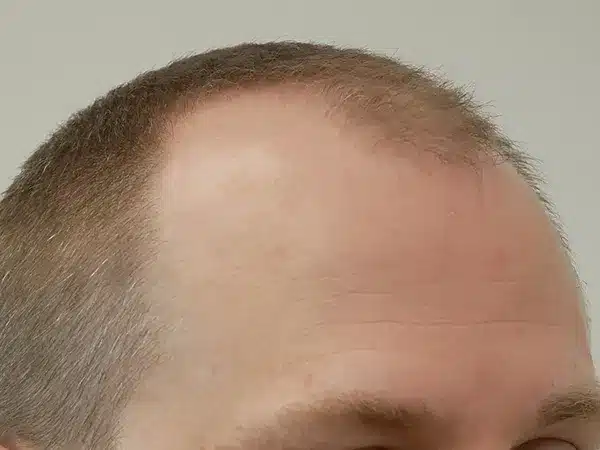 Hair Restoration