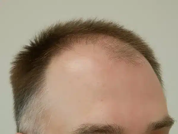 Hair Restoration