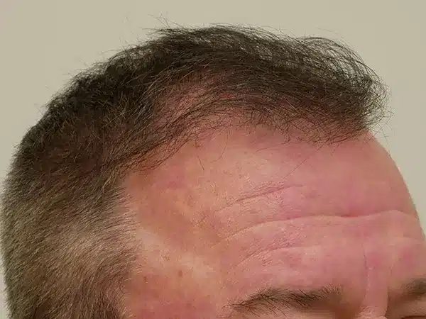 Hair Restoration