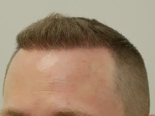 Hair Restoration