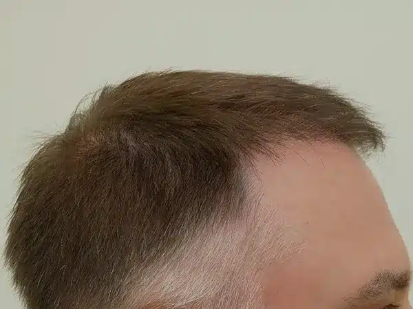 Hair Restoration
