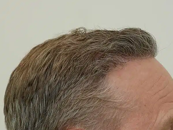 Hair Restoration