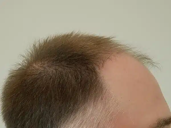 Hair Restoration