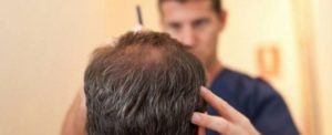 Recent History Of Hair Transplants