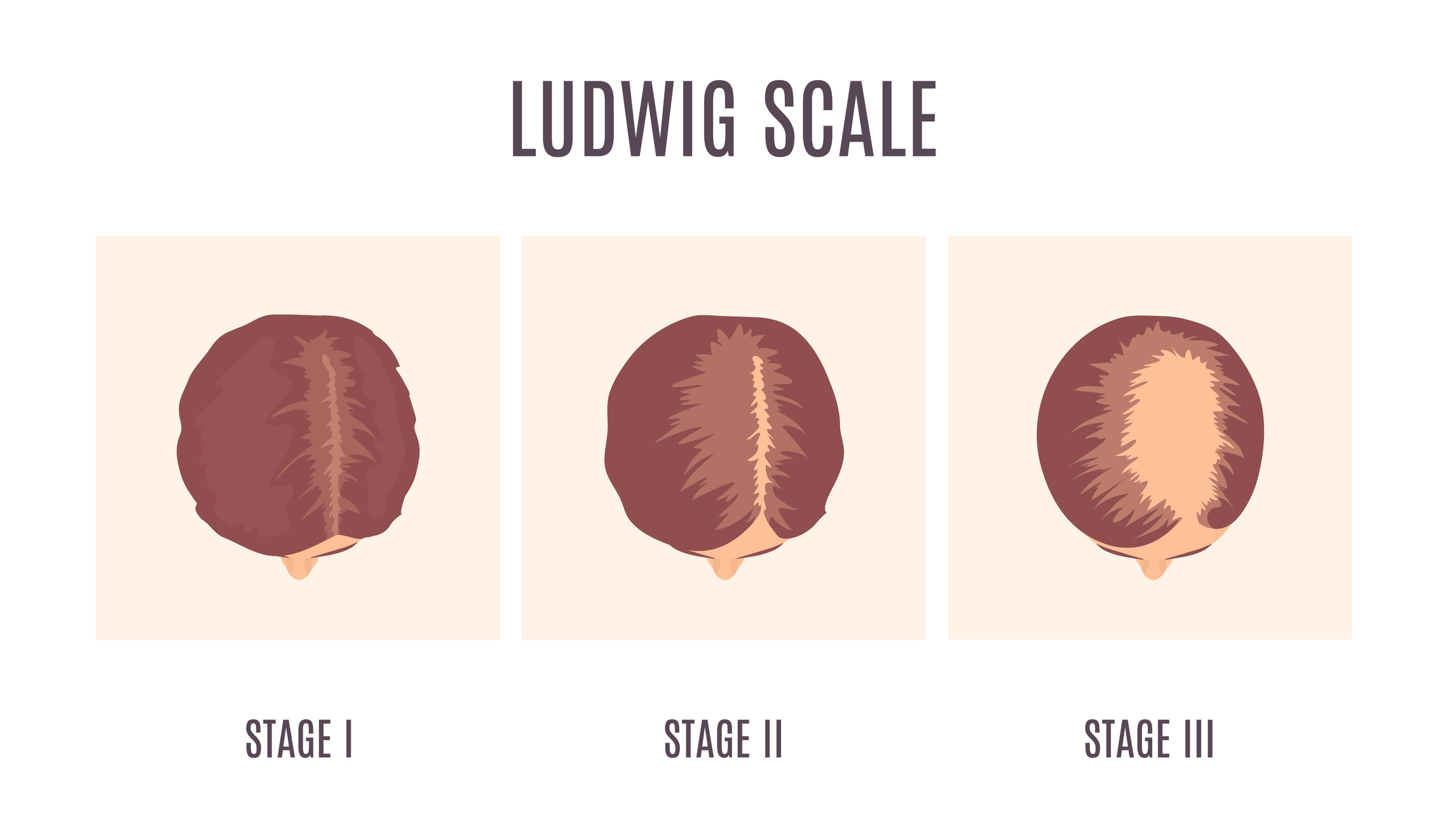 Ludwig Scale - female hair loss