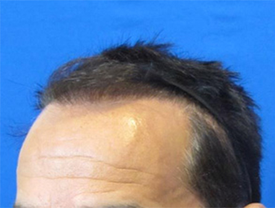 Hair Restoration