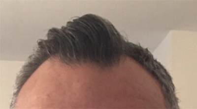 Hair Restoration