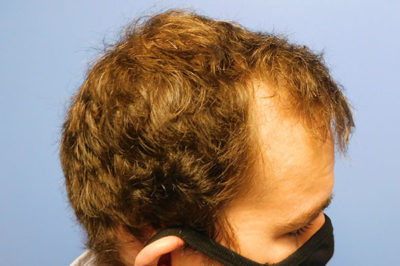 Hair Restoration