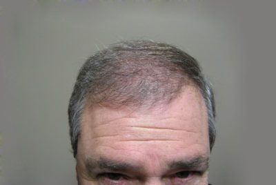 Hair Transplant