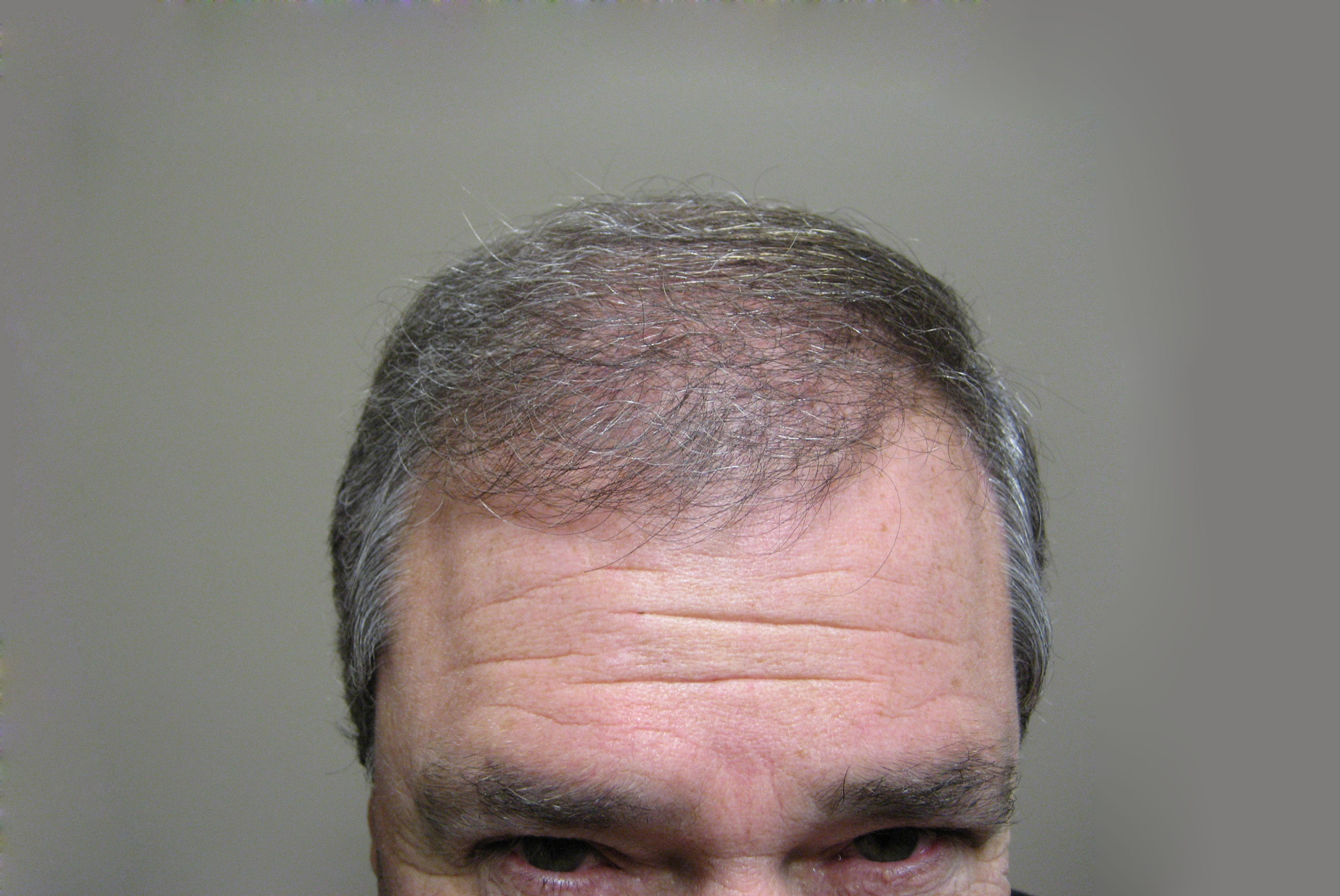 Hair Restoration