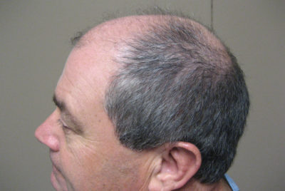 Hair Transplant