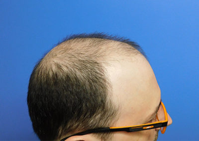 Hair Transplant