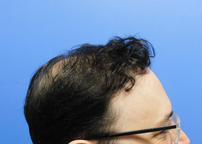 Hair Transplant