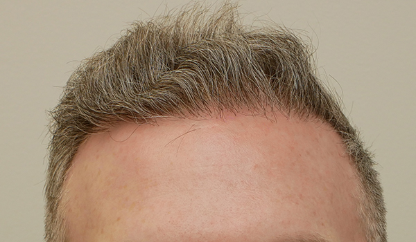 Hair Restoration