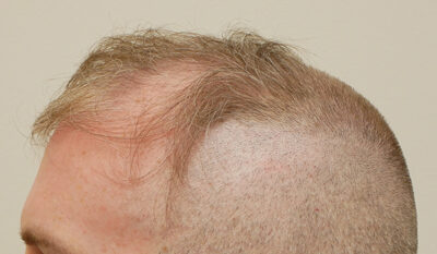 Hair Restoration