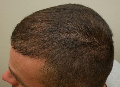 Hair Restoration