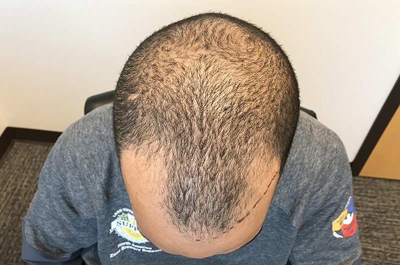 Hair Restoration