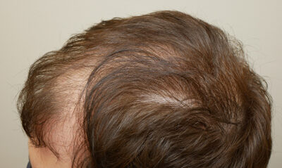 Hair Restoration