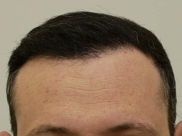 Hair Restoration