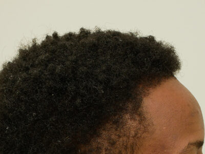 Hair Restoration