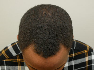 Hair Restoration