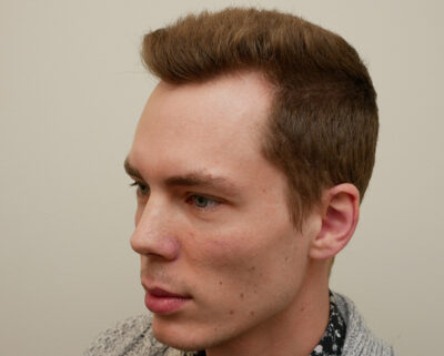 Hair Restoration