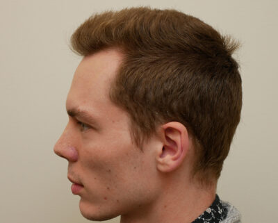 Hair Restoration