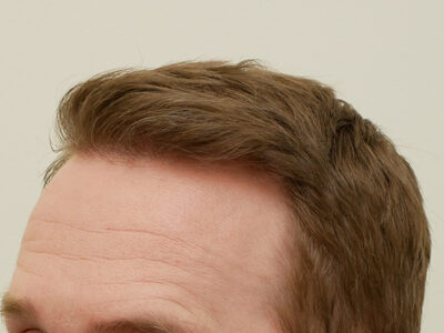 Hair Restoration