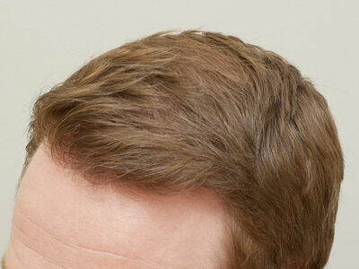 Hair Restoration