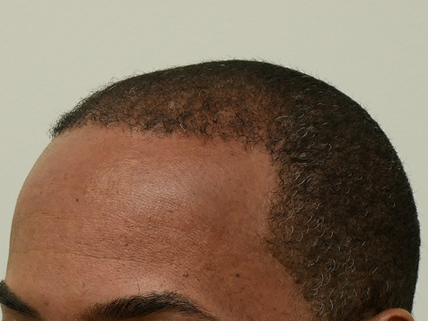 Hair Restoration